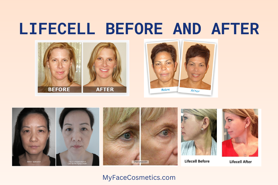 Lifecell Before and after