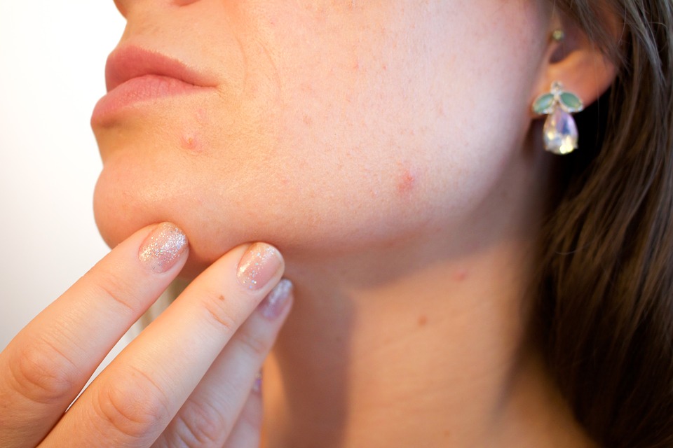 acne pores woman