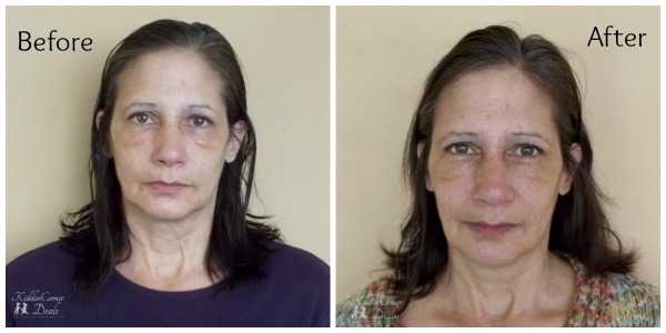 Before and After Elite Serum RX