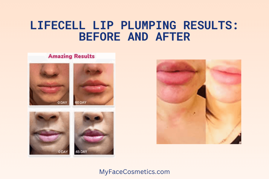 lifecell lip plumping treatment before and after results
