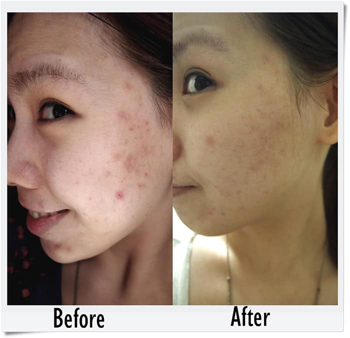 Neostrata before and after testimonial