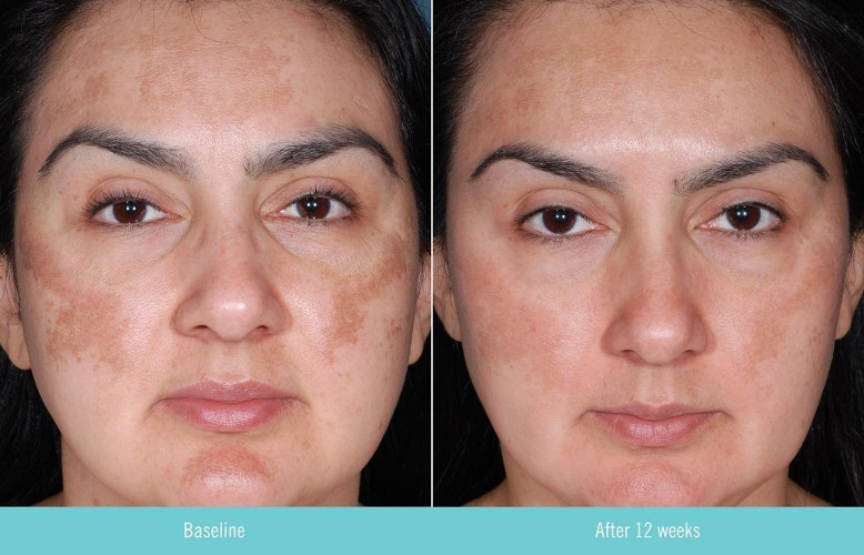 Obagi Nu Derm Clear before and after
