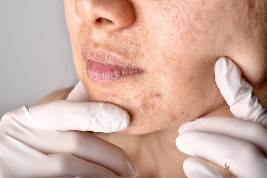 treating fungal acne