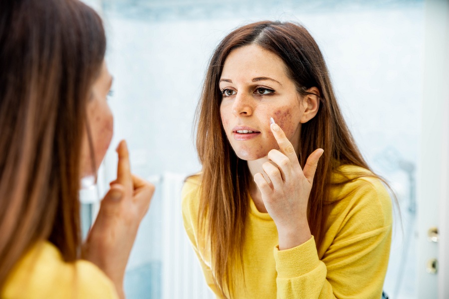 woman applying skin acne cream treatment